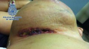 La cocaína estaba oculta en prótesis mamarias implantadas. 