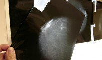 Fotografía de archivo, tomada en Bilbao el 07-02-07, de una prueba radiológica de mama.