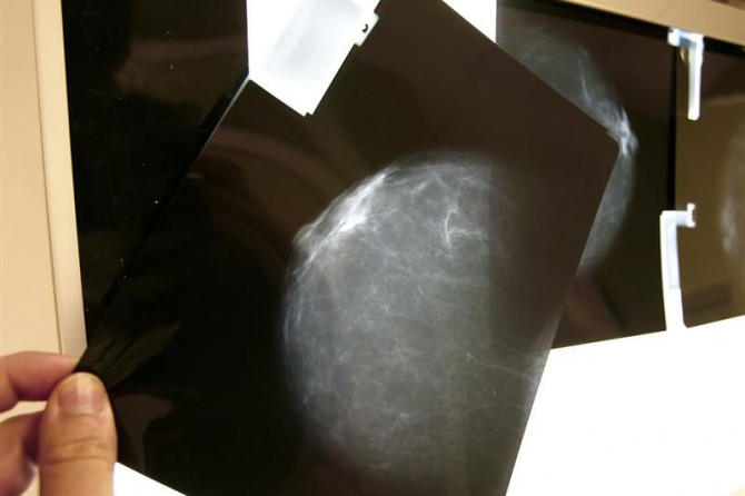Fotografía de archivo, tomada en Bilbao el 07-02-07, de una prueba radiológica de mama. 