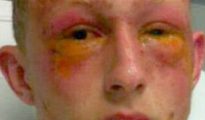 Estado en el que quedó el rostro del más grave de los adolescentes atacados. Ha perdido la visión de su ojo izquierdo.