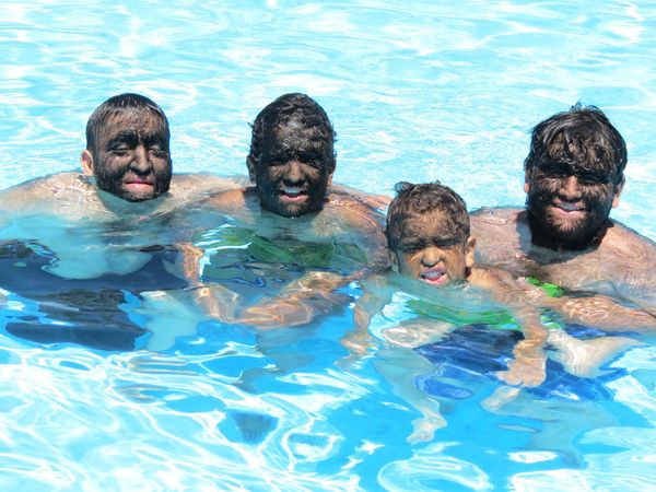 El Síndrome del Hombre Lobo es hereditario, causado por una mutación genética.