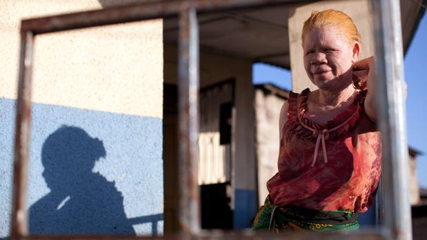 Imagen de archivo de una mujer de raza negra y albina