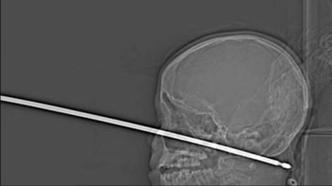 Radiografía del menor con la brocheta en la cara.