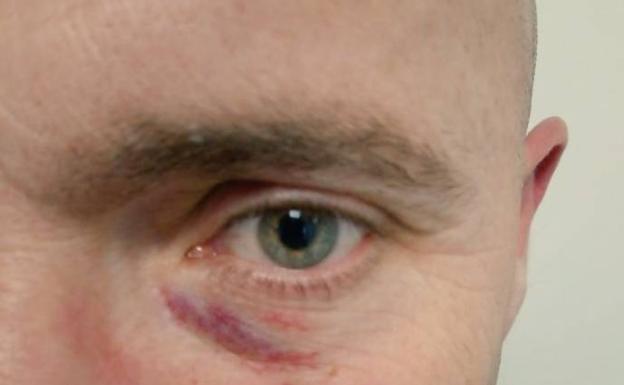 Juan Manuel Rosales muestra las heridas provocadas por el golpe.