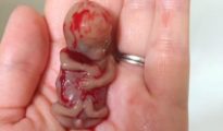 En la imagen, un feto abortado de 11 semanas. En España, sería un aborto de trámite incluso para menores de edad. Se puede ejecutar hasta la semana 22