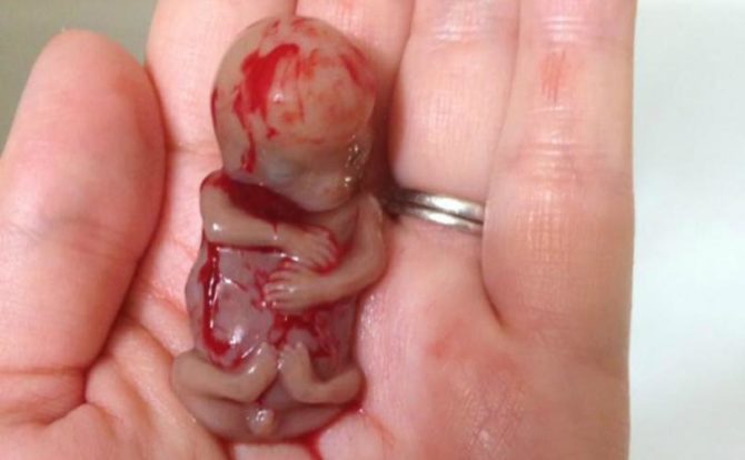 En la imagen, un feto abortado de 11 semanas. En España, sería un aborto de trámite incluso para menores de edad. Se puede ejecutar hasta la semana 22